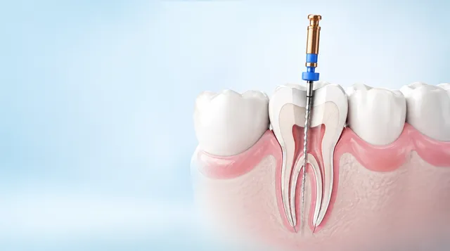 Endodontia (Tratamento de Canal)